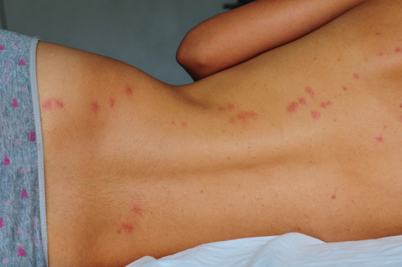 "Two-day old bedbug bites on a woman's backFor photo of same model, but standing and with buttocks partially exposed to reveal the most vivid bites: http://www.istockphoto.com/stock-photo-13024518-bedbug-bites.php"